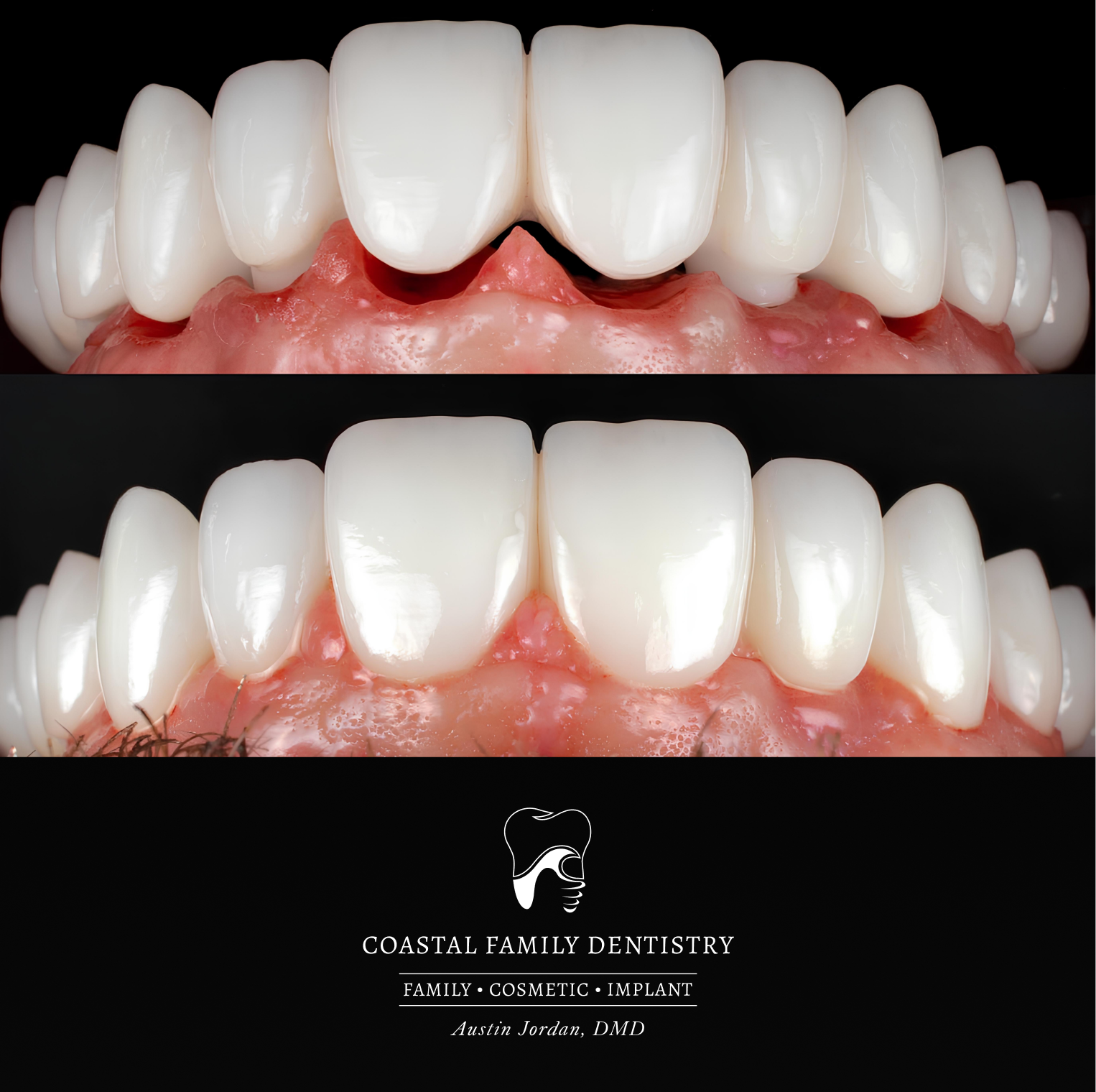 Porcelain Implant Bridge
